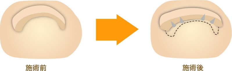 施術前と施術後のイラスト