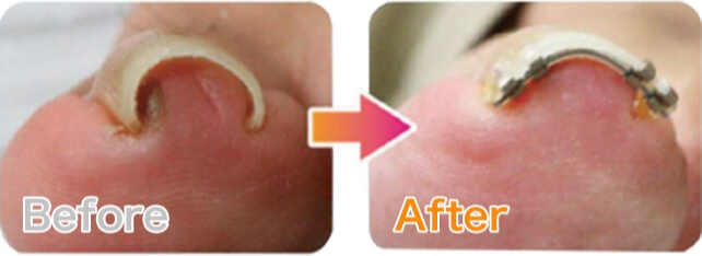 施術前と施術後の画像