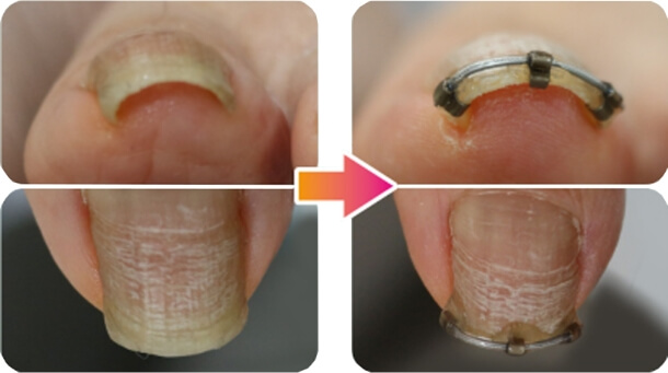 矯正前と矯正後の比較画像