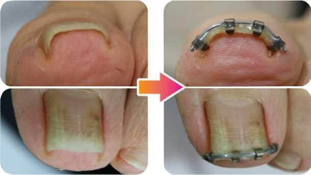 矯正前と矯正後の比較画像