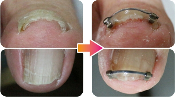 矯正前と矯正後の比較画像